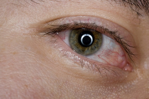 Dry Eye Syndrome treatment
