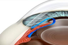 Long Beach Glaucoma Treatment & Surgery 